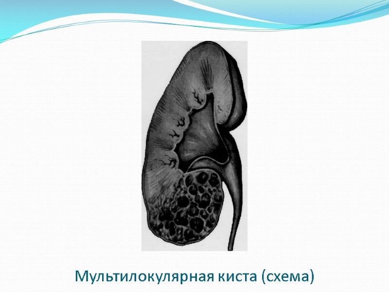 Мультилокулярная киста (схема)